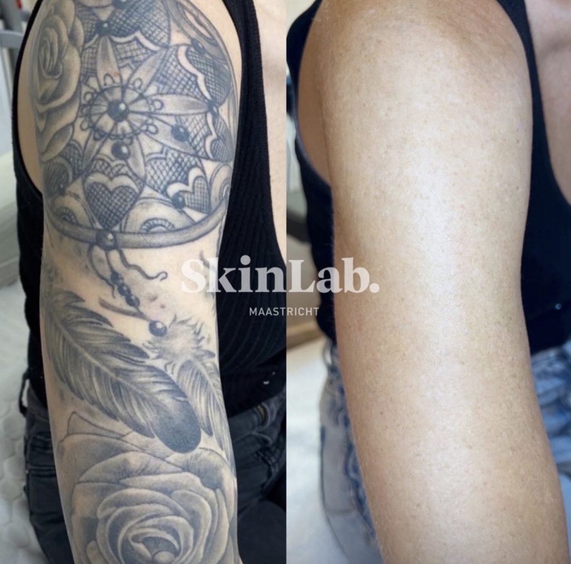 Tatoeage verwijderen met laser bij SkinLab Maastricht
