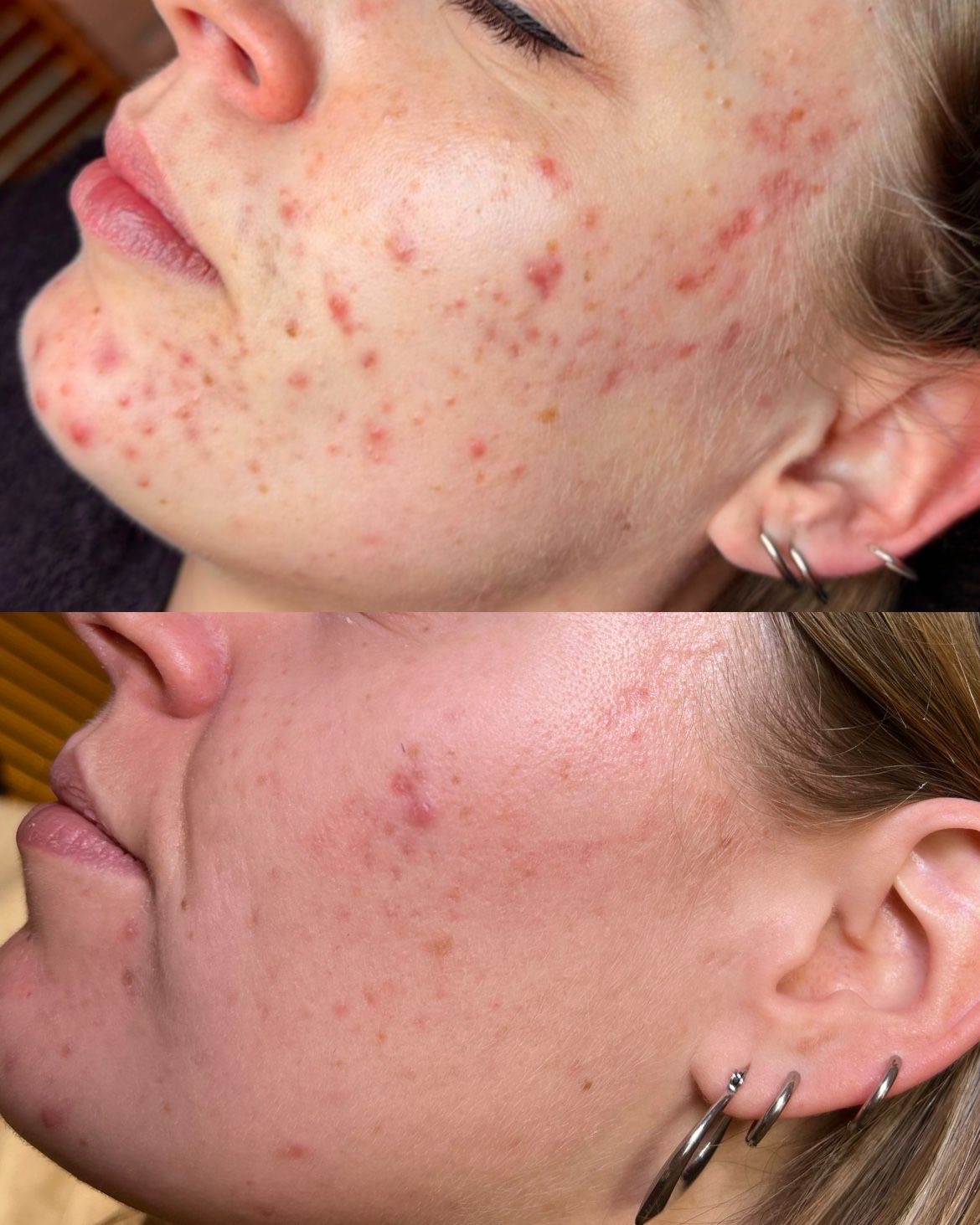 Acnebehandeling bij een huidtherapeut van SkinLab Maastricht