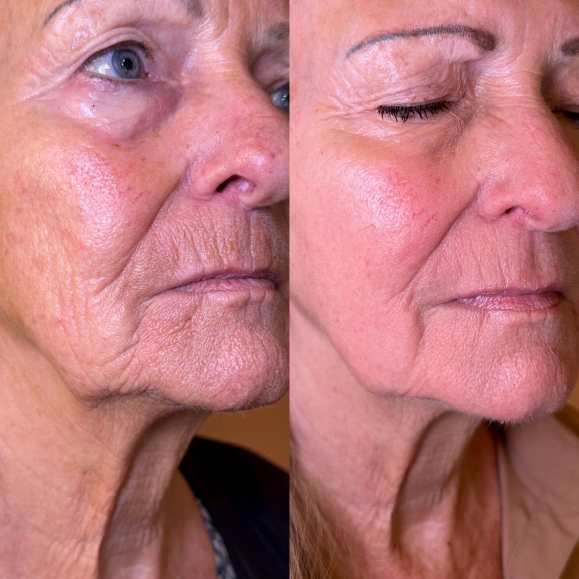 Anti-agingbehandeling bij SkinLab Maastricht