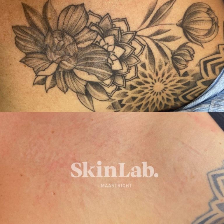 Tattoo verwijderen Tattoo removal SkinLab Maaastricht voor en na