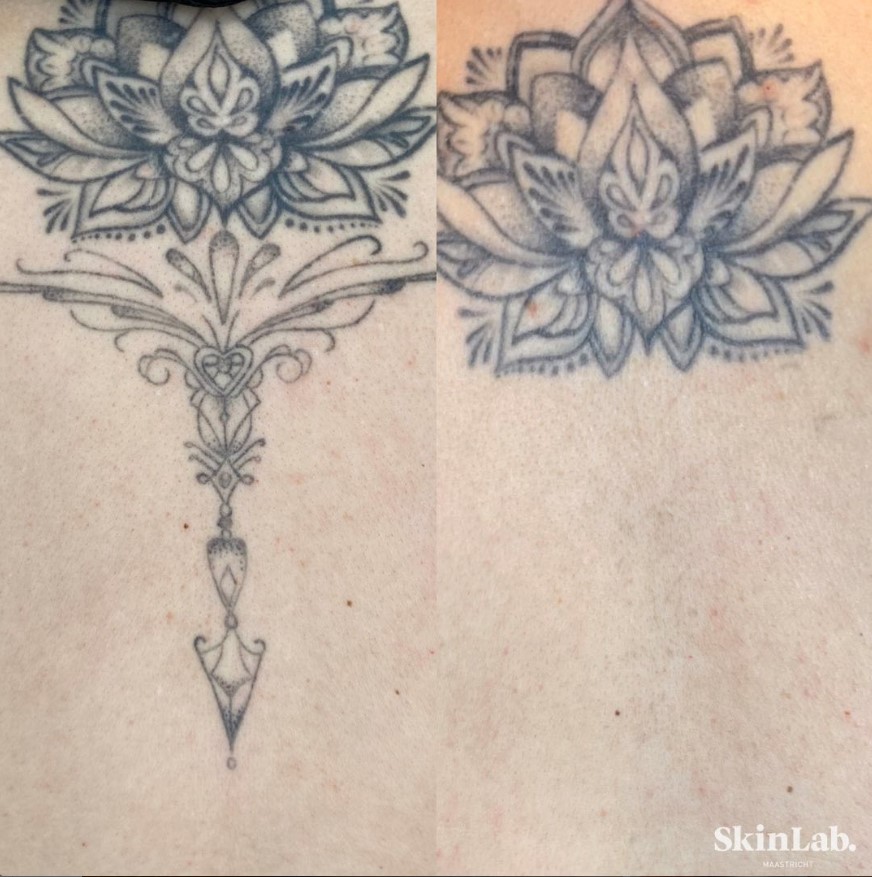Tattoo verwijderen met laser Tattoo removal SkinLab Maaastricht voor en na