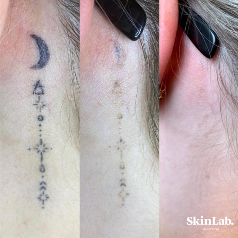 Tattoo verwijderen met laser bij SkinLab Maastricht voor en na foto 1