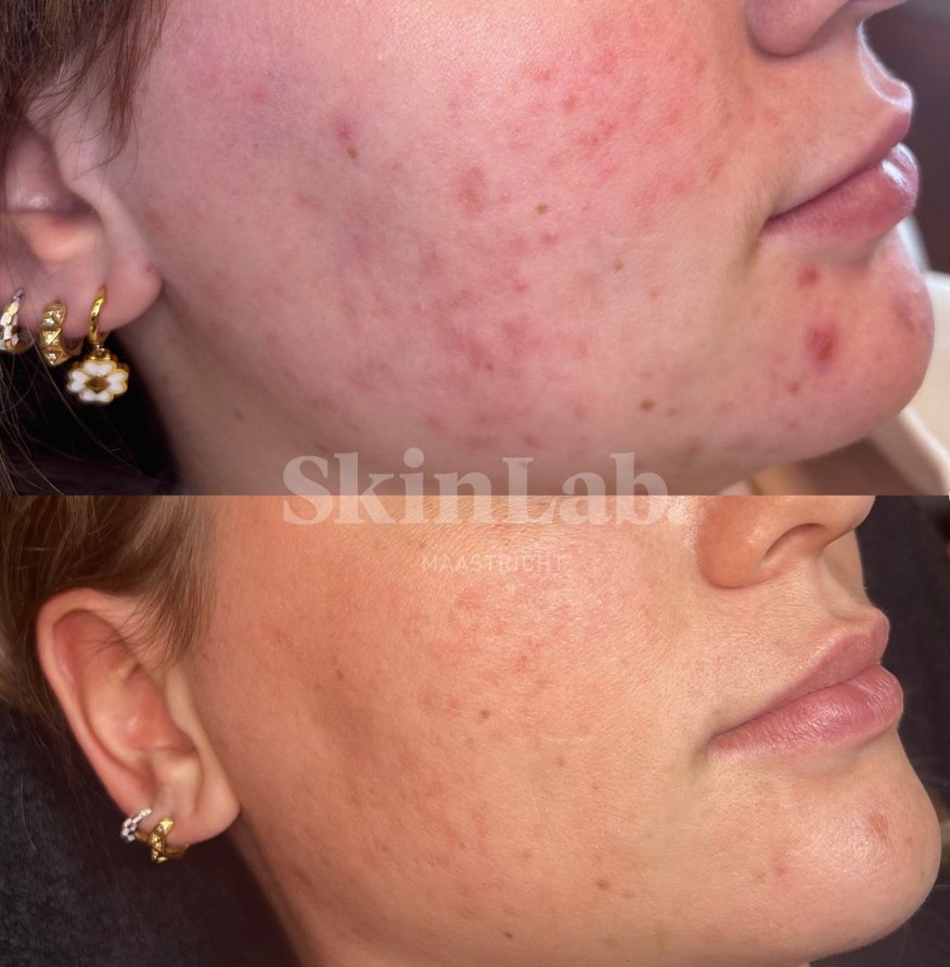 Acne behandeling bij SkinLab Maastircht voor en na