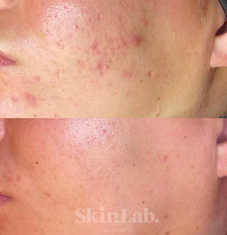 Acne littekens behandelingen bij SkinLab Maastricht voor en na