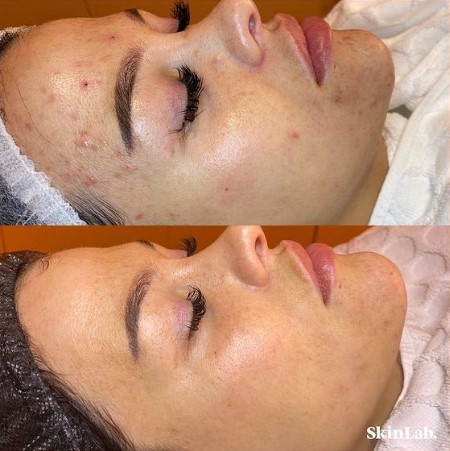 Skinlab Maastricht SkinPen Microneedling behandeling voor en na