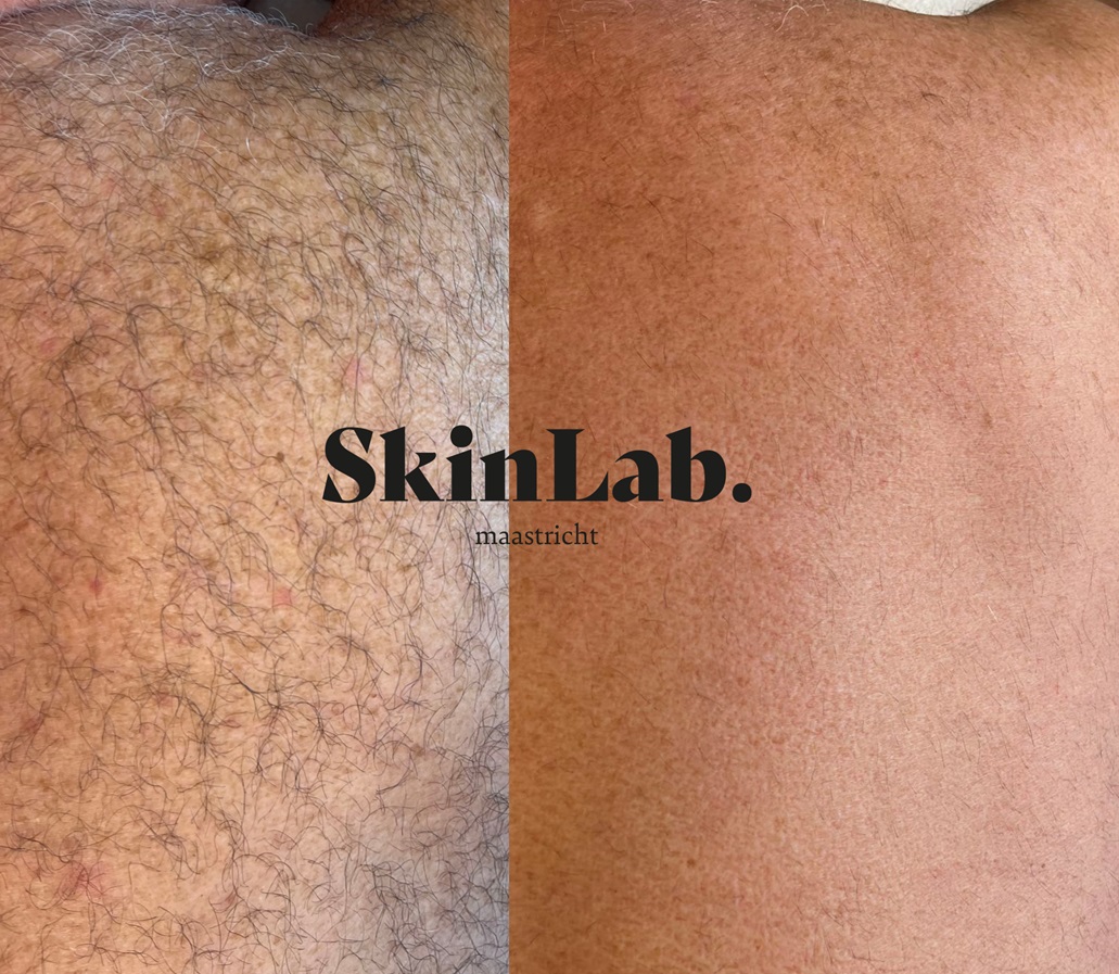 laserontharing borst of rug skinlab maastricht 2