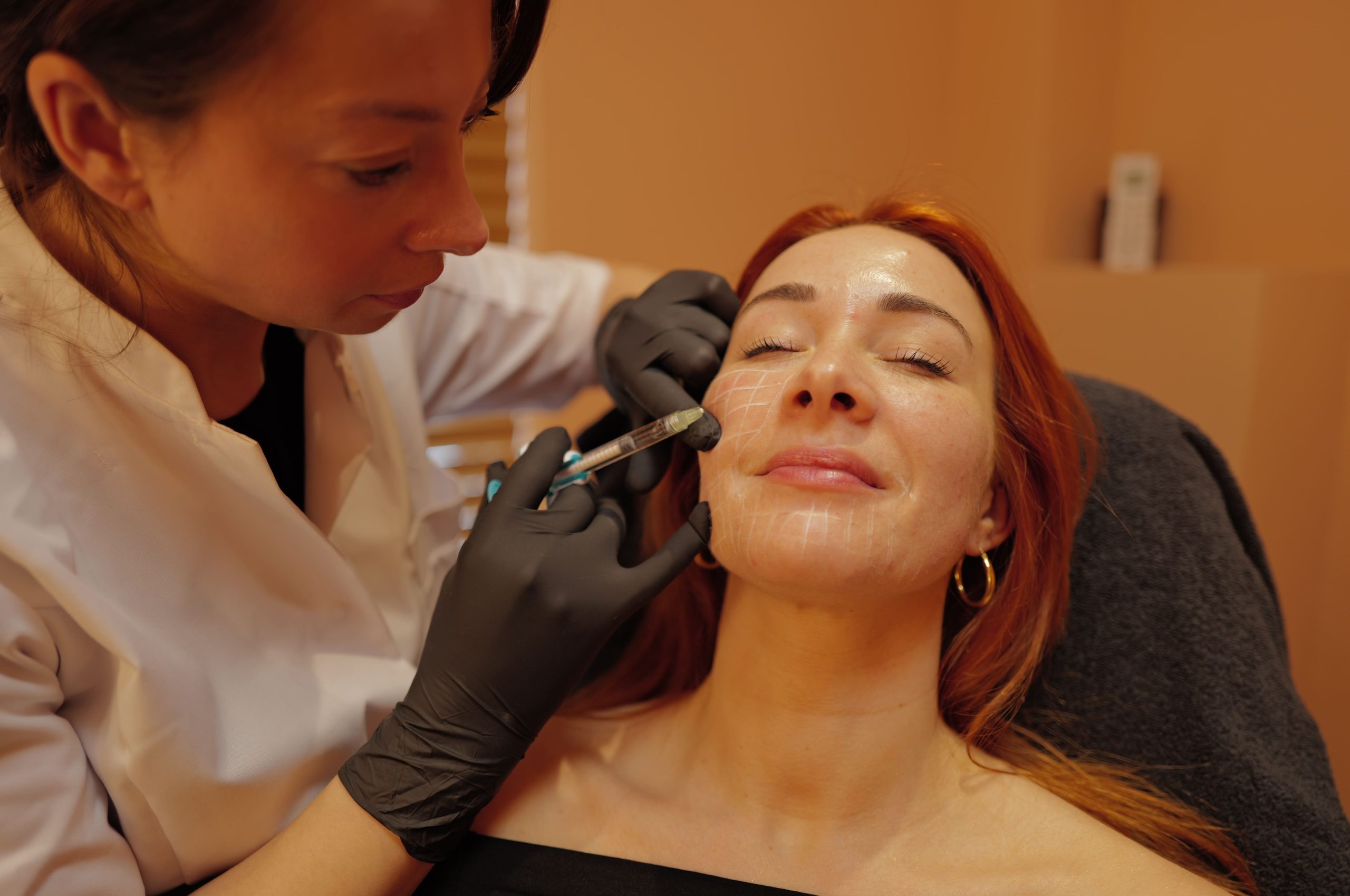 Fillerbehandeling van de lippen