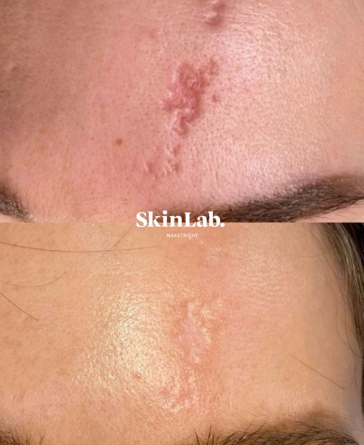 beste resultaten skinlab maastricht littekens verwijderen