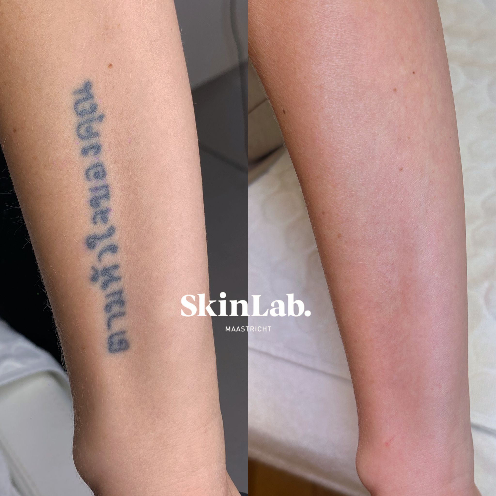Tattoeage verwijdering 5