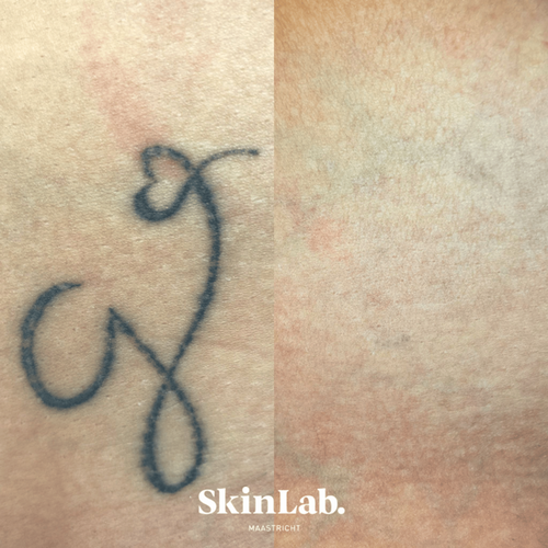 tatoeage verwijdering