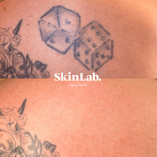 tatoeage verwijdering