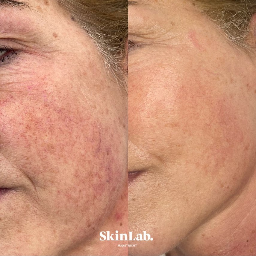 skinlab maastricht voor en na rosacea