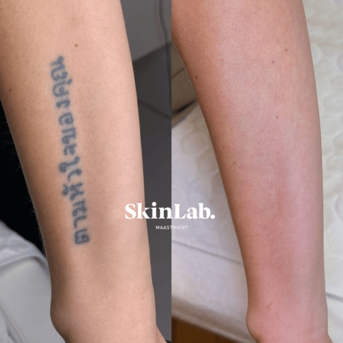 tatoeage verwijdering