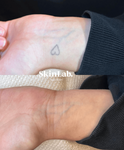 tatoeage verwijdering