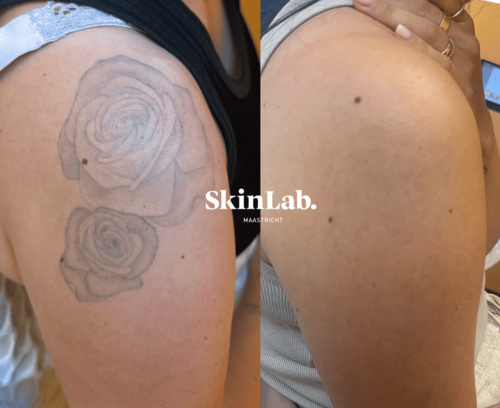 tattoeage verwijdering