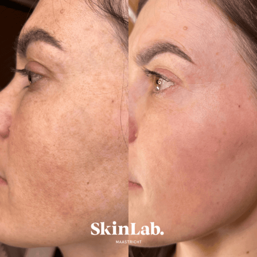 ultraclear laser skinlab